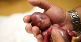 Miquel Blanc: “El aborto es la mayor injusticia de la historia de la humanidad, con 55 millones de muertos cada año”