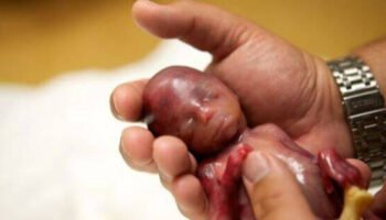 Miquel Blanc: “El aborto es la mayor injusticia de la historia de la humanidad, con 55 millones de muertos cada año”