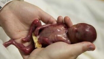 Durante 2021, 43 millones de niños fueron asesinados en el seno materno