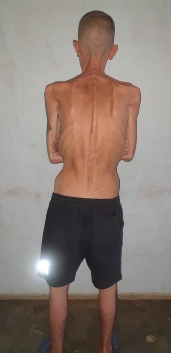 Vista posterior de Alexander Díaz Rodríguez, un hombre con calvicie, torso extremadamente delgado con costillas y columna vertebral prominentes, vistiendo shorts oscuros